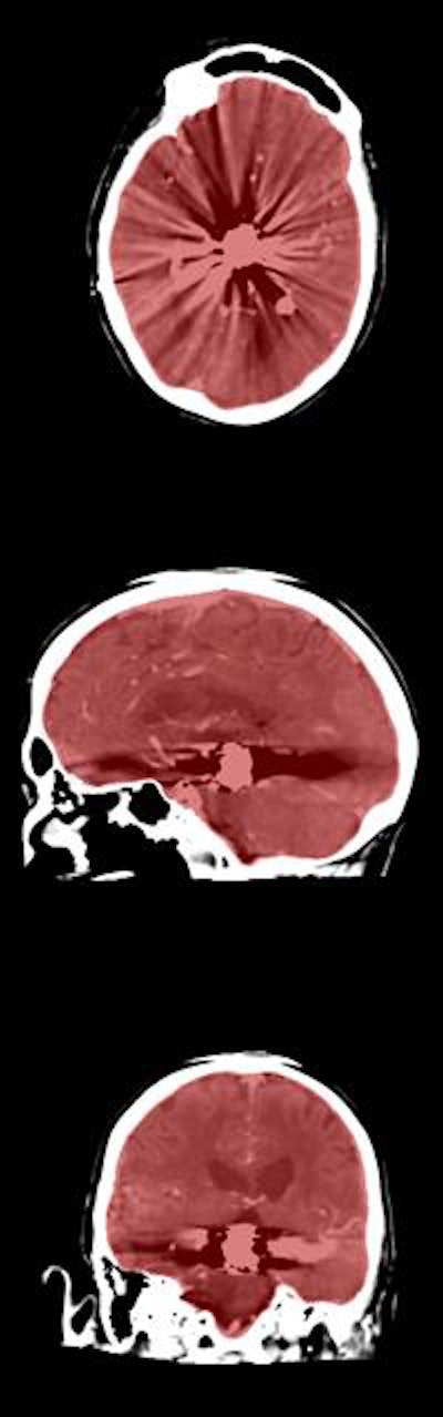 Axial, sagittal, and coronal CT views of final cranial cavity segmentation for a patient with a large metallic foreign object between cerebral soft tissue.