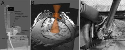 Images show technology and methodology involved in MRI-guided transplantation of neural stem cells into the Parkinsonian brain. Courtesy of Cell Transplantation.