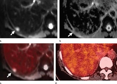 Axial PET/MRI (a-c) and PET/CT (d) images are from a 64-year-old woman with a history of left breast cancer metastatic to lung and bone. Images were obtained to monitor response during chemotherapy. A liver metastasis (arrow) is seen on PET/MRI (a-c), but not on PET/CT (d). The metastasis is best seen on the diffusion-weighted MR image (a), with corresponding low signal intensity on the apparent diffusion coefficient map (b). There is minimal corresponding FDG uptake on the fused diffusion-weighted and PET image (c). The metastasis is not seen on PET/CT images (d). Images courtesy of Radiology.