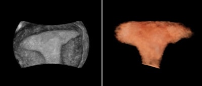 Uterus shape visualized with 3D thick-slice image (left) and 3D volume (right). All images courtesy of ContextVision.
