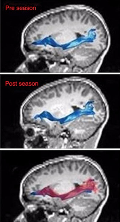 MRI shows the left inferior fronto-occipital fasciculus before (top) and after (middle) the playing season. In an overlay of the two images (bottom), the red region illustrates the brain after the season, while the blue region represents the brain before the season. Image courtesy of Radiology.