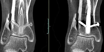 A weight-bearing extremity scan acquired with OnSight 3D. Screw threads are more visible in the image at left after metal artifact correction is applied. Image courtesy of Carestream Health.