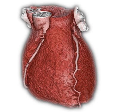 Three-dimensional CT scan shows normal coronary arteries. Images courtesy of Dr. Marc Dewey and the German Radiological Society (Deutsche Röntgengesellschaft, DRG).