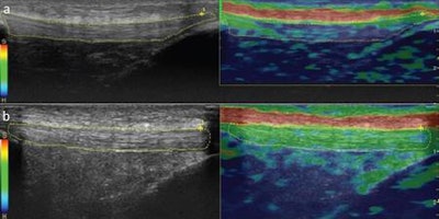 Sonograms and color-coded images of the patellar tendon of a smoker (A) and a nonsmoker (B). The smoker's patellar tendon has a grade 1 (hardest tissue) blue color code, while the nonsmoker's tendon has a grade 3 (intermediate tissue) green color code. Images courtesy of the Journal of Ultrasound in Medicine.