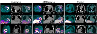 F-18 florbetaben PET appeared promising for differentiating between cardiac amyloidosis and hypertensive heart disease. Image courtesy of W. Phillip Law, Princess Alexandra Hospital, Brisbane, Australia.