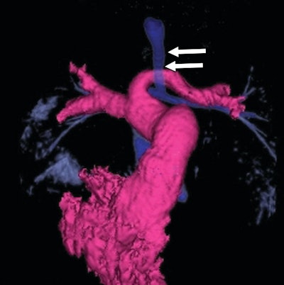 3D reformat from CT performed two weeks later, showing left pulmonary artery sling and diffusely narrowed trachea (arrows) secondary to complete tracheal rings, which are commonly associated with this type of vascular ring.