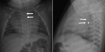 Images are of a 4-month-old boy with breathing difficulty. Frontal (left) and lateral (right) chest radiographs show diffuse narrowing of intrathoracic trachea (arrows, left) and subtle anterior displacement of inferior trachea (arrows, right) by soft-tissue density (asterisk, right) interposed between trachea and esophagus. These findings were not described on the report. Images courtesy of AJR.