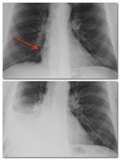 Example of the silhouette sign on chest x-ray. (Quick note to avoid confusion: X-rays are viewed so that the left side of the image is the right side of the patient, as if the patient is facing you). Top image: normal chest x-ray. The right border of the heart is well seen next to the lungs (red arrow). Bottom image: silhouette sign in the same patient. A pleural effusion obscures the right border of the heart.