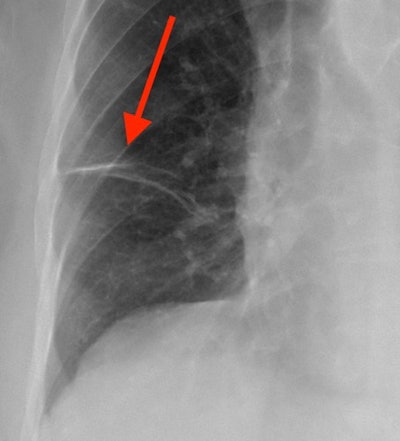 Scarring. Magnified image of the right lower lung shows linear densities representing small areas of scarring.