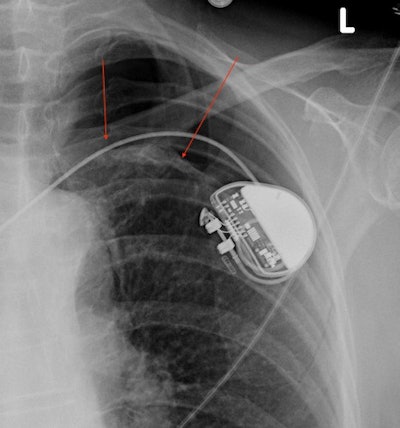 Left-sided pneumothorax. Red arrows mark the edge of the lung, with gas in the pleural cavity (pneumothorax) above this level. A cardiac pacemaker partially obscures this part of the lung.