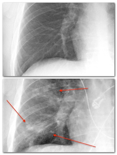 Consolidation in the setting of pneumonia. Top image: magnified image of the right lower lung in a normal patient. Bottom image: areas of pneumonia in the same patient.