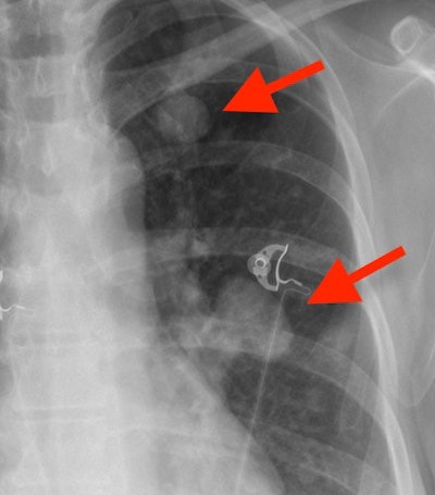 Pulmonary (lung) nodules. Magnified image of the left upper lung shows several pulmonary nodules in this patient with cancer that has spread to the lungs.