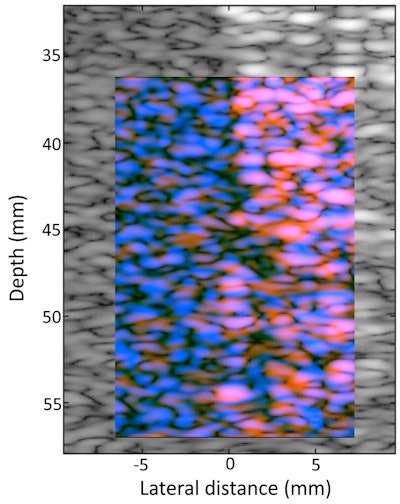H-scan image of a phantom. The pinkish-red colors indicate larger scatterers, while the blue color indicates smaller scatterers. All images courtesy of Kevin Parker, PhD, and the University of Rochester.