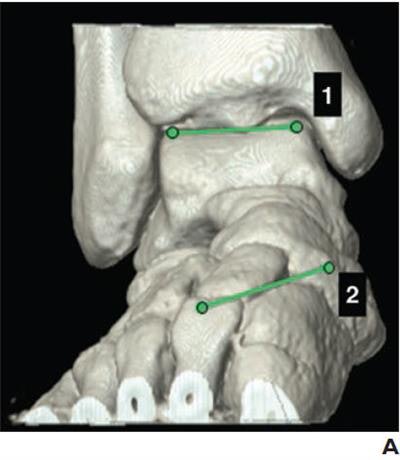 Position of reference markers for two measurements evaluated in 29-year-old female healthy volunteer. All markers were placed on multiplanar reformats on cortical bone. Volume-rendered (A, above) and coronal (B, below) CT images at bimalleolar plane show coronal talocalcaneal angle-measuring procedure. Angle between lines 1 and 2 represents coronal talocalcaneal angle, which was 14.6° in this case.