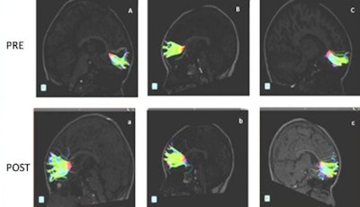 DTI-MRI (Pre A, B, C) shows fibers in the greater forceps of the brain before musical training. Larger fibers from the same patients are shown after nine months of musical training (Post a, b, c). Image courtesy of RSNA.