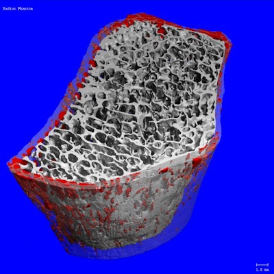 Image acquired using a Scanco Medical XtremeCT scanner. Courtesy of RSNA.