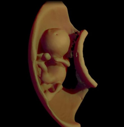 Above, 3D virtual model ultrasound view of fetus at 12 weeks. Below, 3D virtual model MRI view of fetus at 26 weeks. All images courtesy of the authors and RSNA.
