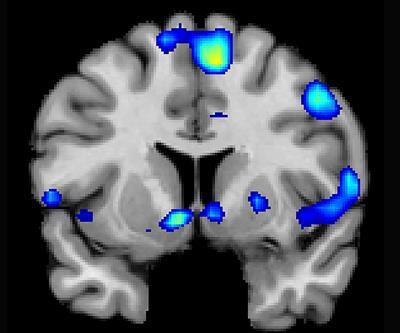 fMRI shows where several brain regions, including the nucleus accumbens, became active when devoutly religious individuals reported having a spiritual experience. Image courtesy of Dr. Jeffrey Anderson, PhD.