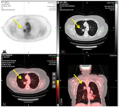 FDG-PET/CT shows a pulmonary metastasis in a cervical cancer patient. PET (upper left), CT (upper right), and PET/CT (bottom row) demonstrate an FDG-avid nodule in the right lower lobe consistent with a pulmonary metastasis and confirmed by histology. Image courtesy of Dr. Michael Gee, PhD.