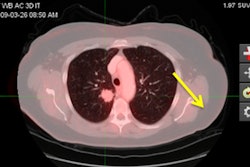 2016 11 27 12 48 08 45 Gee Petct Pulmonary 400