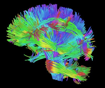 Example of a white-matter rendering from DTI and DKI scans. Image courtesy of RSNA.