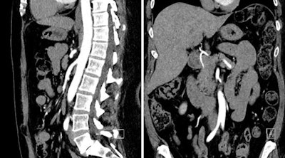 Coronal (above, left), sagittal (above, right), and 3D reconstruction (below) images from abdominopelvic CTA in a 54-year-old woman who was scanned using 15 mL of iodinated contrast at 80 kV. Images courtesy of Dr. Faezeh Sodagari.