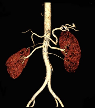 Abdominopelvic CTA in a 54-year-old woman