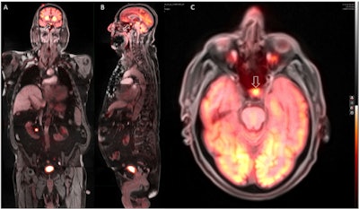 Whole-body PET/MR coronal (A), sagittal (B), and axial (C) images show a hypermetabolic focus in the region of the pituitary gland (C, arrow), which was later confirmed as consistent with an adenoma. Image courtesy of Dr. Ana Franceschi.