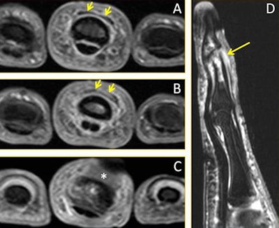A 28-year-old male volleyball player with a finger injury. Consecutive axial fat-suppressed T2-weighted MR images of the third finger: (A) Proximally, there is normal appearance of the distal extensor tendon (short arrows); (B) Distally to A, the distal extensor tendon is thickened with increased signal intensity (arrows); (C) More distally to B, the distal extensor tendon is no longer depicted (*), consistent with a complete distal rupture. (D) Sagittal fat-suppressed T2-weighted MR image of the third finger depicts the complete rupture of the distal extensor tendon (arrow). The associated impaction fracture and bony contusions about the distal interphalangeal joint also are seen. Image courtesy of Dr. Daichi Hayashi, PhD.