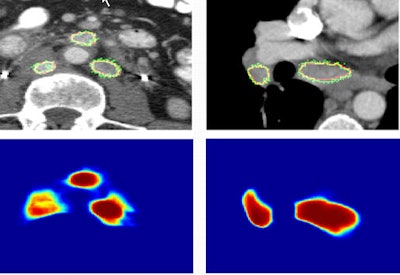 Images show two examples of BNF-based lymph-node segmentation. At left are three retroperitoneal lymph nodes accurately segmented by BNF (green). The reference standard is the red curve. At right are mediastinal and right hilar adenopathy accurately segmented by BNF (green). The bottom row shows corresponding BNF probability maps. Images courtesy of Dr. Ronald Summers, PhD.