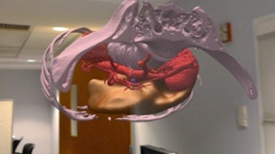 A hologram of a CT abdomen/pelvis performed to evaluate hepatic malignancy. The hologram can be manipulated via voice command and air gestures, supporting an intuitive characterization of anatomy.