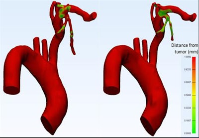 Surgeons noted small differences in segmentation and the area of vessels within 1 mm of tumor (green-yellow) between the two readers, but these did not affect the clinical assessment significantly.