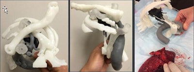 Case 2: The 3D model showed limited chest wall invasion and a mass separate from the subclavian vessels.