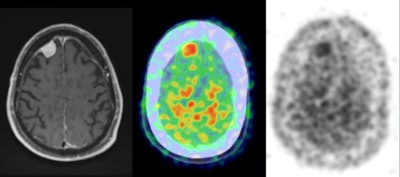 Postcontrast axial T1-weighted MRI demonstrates a right frontal meningioma (left), while the PET/CT axial color map fusion image (center) shows intense PiB activity within the meningioma. Also, an axial PET image (right) demonstrates intense PiB activity within the meningioma. Images courtesy of Dr. Derek Johnson.