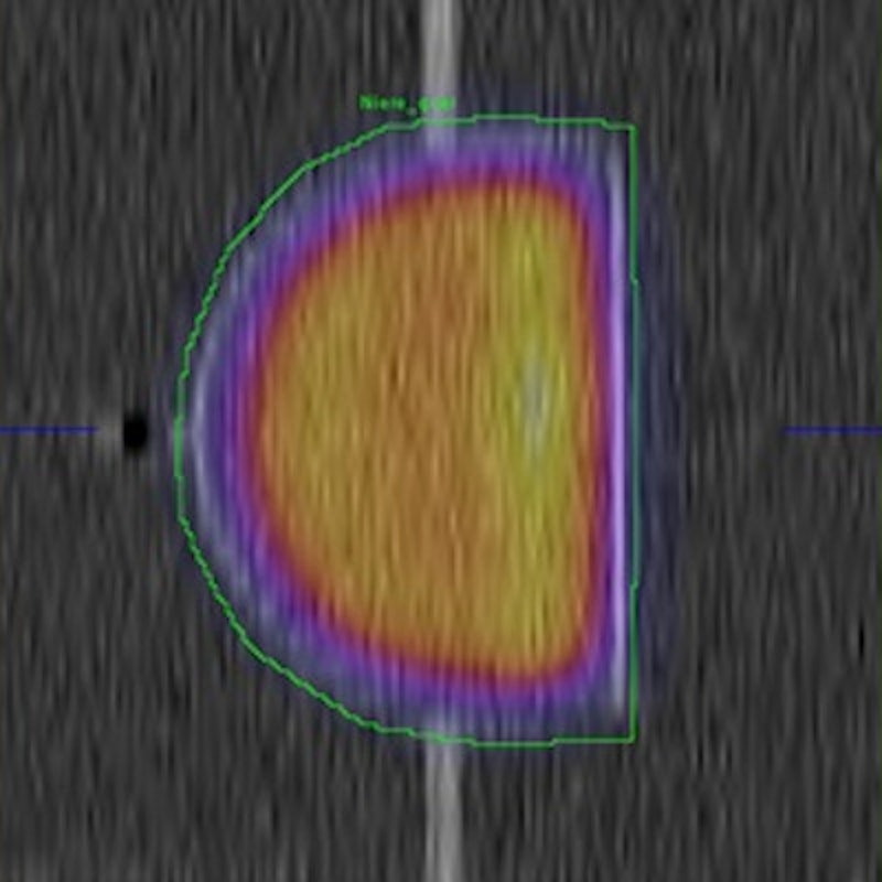 3D-printed kidney phantom advances SPECT/CT calibration | AuntMinnie