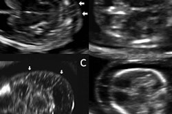 2017 01 16 11 42 57 359 Nuchal 20170116184349
