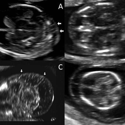 increased nuchal translucency ultrasound in