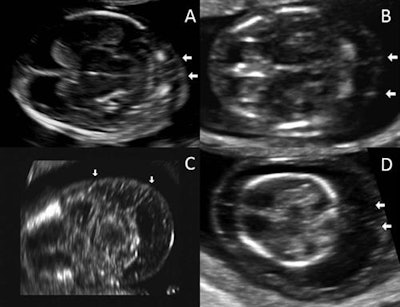 Ultrasound images of nuchal septations in a transverse plane. Image A has a nuchal translucency of 2.3 mm, while image B has a nuchal translucency of 4 mm. Image C has a nuchal translucency of 5.2 mm and image D has a nuchal translucency of 8 mm. All images courtesy of the Journal of Ultrasound in Medicine.