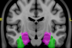 2017 01 18 11 20 58 108 Gibby Hippocampus Fusiform 400