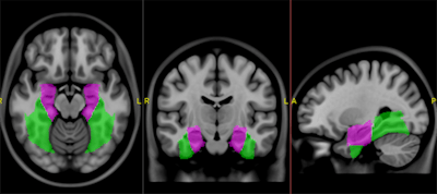The Gibby-Cvetko atlas segments the fusiform gyrus (green) within the hippocampus (purple). Image courtesy of Dr. Wendell Gibby.