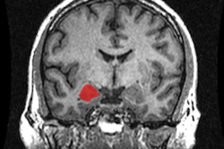 2017 01 19 10 28 54 496 Amygdala Neuro Image 400