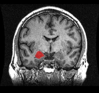 MRI shows a coronal view of the amygdala (red). Image courtesy of Rosalind Franklin University of Medicine and Science.