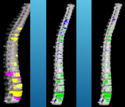 CAD reference data and detections. Left: reference lesions (yellow: sclerotic, cyan: lytic, purple: mixed). Middle: detections before classification. Right: detections after classification (green: true positive, blue: false positive).