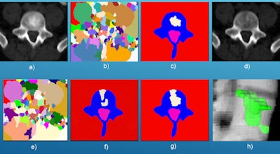 Spinal lesion candidate detection and segmentation process: (a) sclerotic synthesis of prior mixed lesion, (b) watershed for 'a,' (c) graph cut for 'b,' (d) lytic synthesis of prior mixed metastasis, (e) watershed for 'd,' (f) graph cut for 'e,' (g) merging of sclerotic and lytic detections, and (h) 3D mixed metastasis detection.