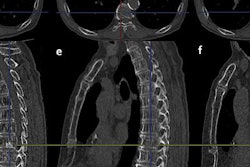 2017 01 26 14 59 42 611 2017 Iwano Osteoblastic Met 20170126220858