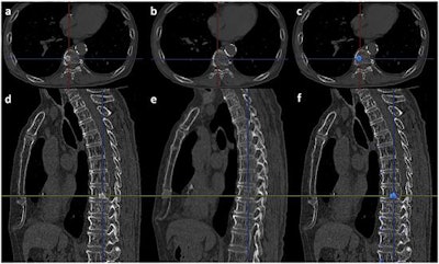 A case of osteoblastic metastasis in the body of the ninth thoracic vertebra. (a) Follow-up axial image. (b) Initial axial image. (c) Result of the 3D CT subtraction. The blue color indicates the metastasis. (d) Follow-up sagittal image. (e) Initial sagittal image. (f) Result of the 3D CT subtraction. The blue color indicates the metastasis. Image republished courtesy of PLOS One, January 17, 2016.