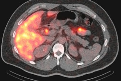 SPECT/CT image of a 35-year-old woman with a small bile leak at the cholecystectomy site. Image courtesy of Dr. Elham Safaie.