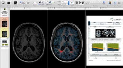 Segmentation techniques make it possible to extract very detailed, quantitative information from 3D datasets of the brain in MS patients. Left: Axial slice of MP-RAGE T1-weighted 3D set through the brain of MS patient. Middle: Image displays same slice after application of segmentation technique, showing MS lesions (or plaques) in red and cortical gray matter in blue. Right: Automatically generated report reveals exact volume of white matter lesions and cortical gray matter, and comparing the values of the patient against age- and sex-matched normal individuals. Such quantitative methods provide accurate follow-up and treatment monitoring of patients with multiple sclerosis because they allow sequential assessment of both white matter lesions and cortical gray matter atrophy. Figure courtesy of Dr. Paul Parizel, PhD.