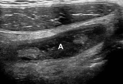 Long-axis sonogram from a 19-year-old man with gangrenous appendicitis without perforation. Image shows global loss of the submucosal layer of the appendix (A).