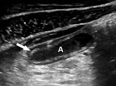 Long-axis sonogram of the distal appendix (A) in a 14-year-old girl with uncomplicated appendicitis. Arrow shows complete preservation of the normal echogenic submucosal layer. All images courtesy of the Journal of Ultrasound in Medicine.